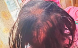三岁女童眼神呆滞，突发脱发竟是铊中毒